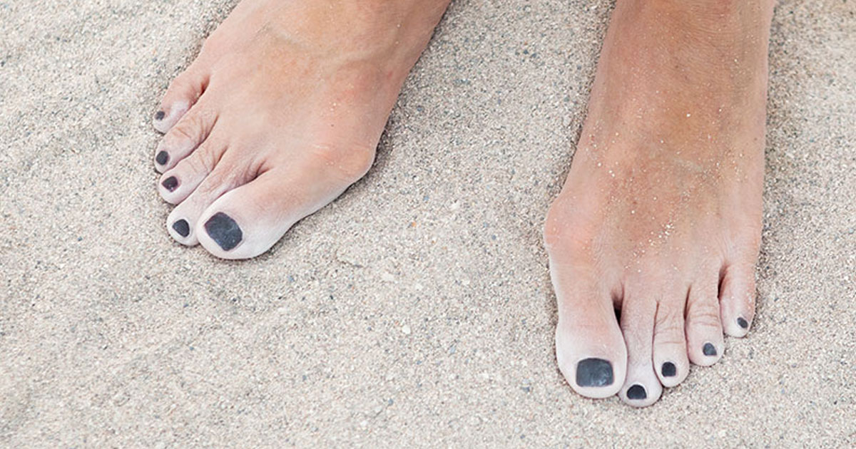 Orthopaedic Surgeon Dr Danielle Wadley discusses bunions – what they are, how they happen, and how to treat them.